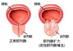 前列腺囊肿的不同特征表现